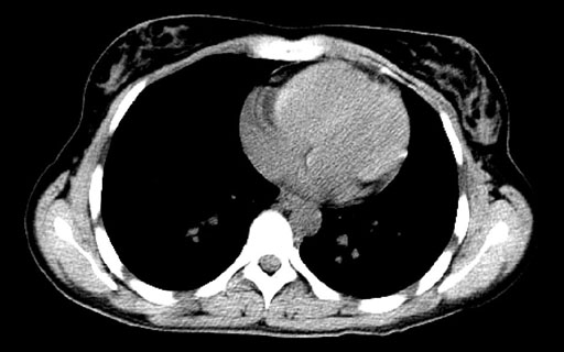 DICOM CT Scan Workstation written by
Mitchell P. Laks, MD, PhD
Montefiore Medical Center
Using POGL, PDL and dcmtk